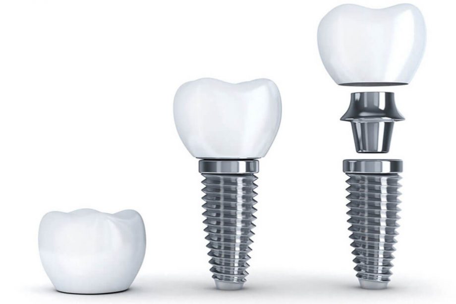 dental implant graphic image