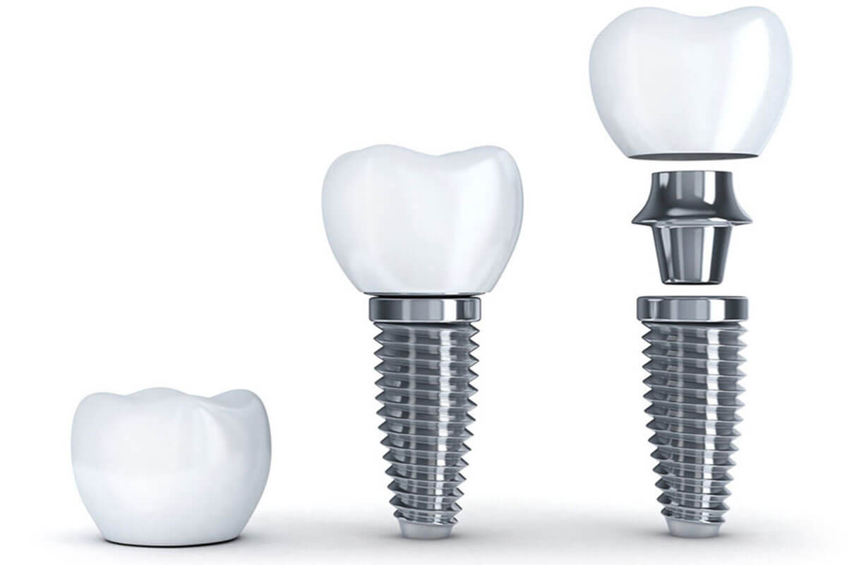 Denture Implants Gold Coast  - South Coast Implant & Cosmetic Dentist.
