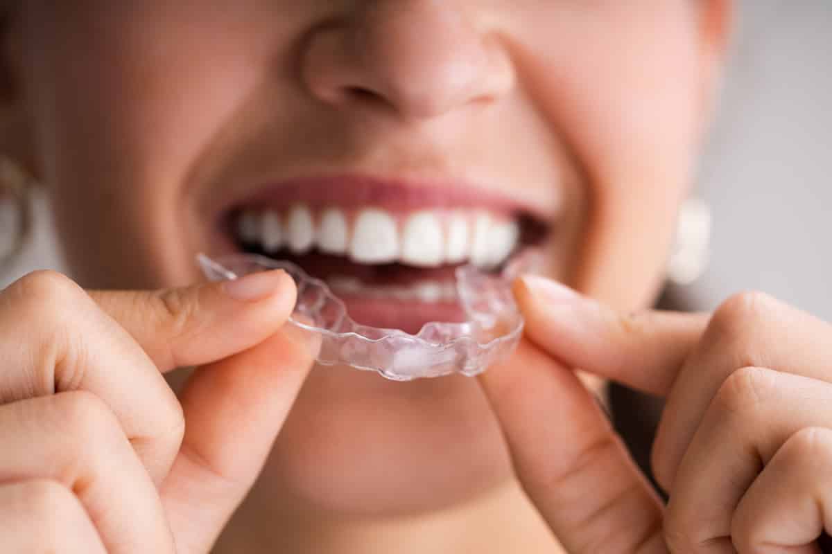 Can Invisalign Fix An Overbite? Glen Cove, NY
