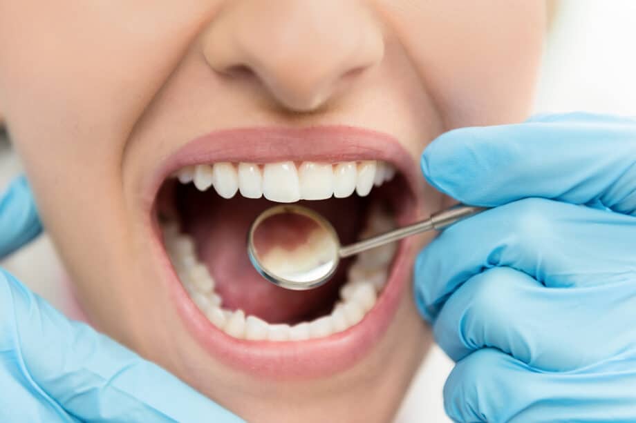 Cavities vs Staining: How to Tell the Difference
