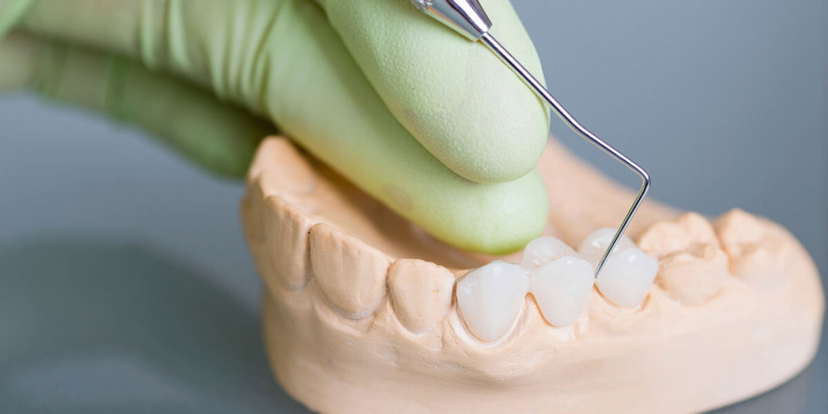 Veneers, Glen Cove, NY