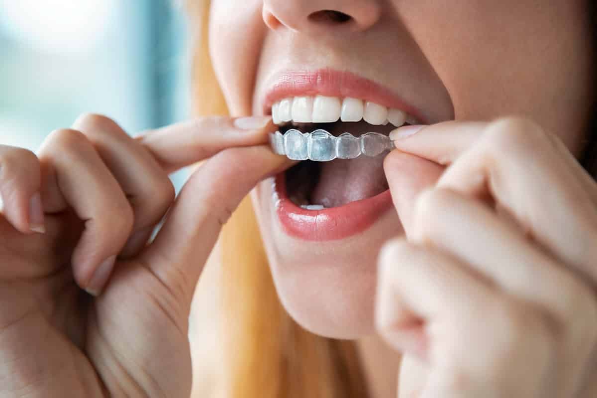 How Does Invisalign Work? Glen Cove, NY