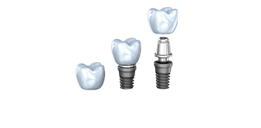 Dental Implants Image